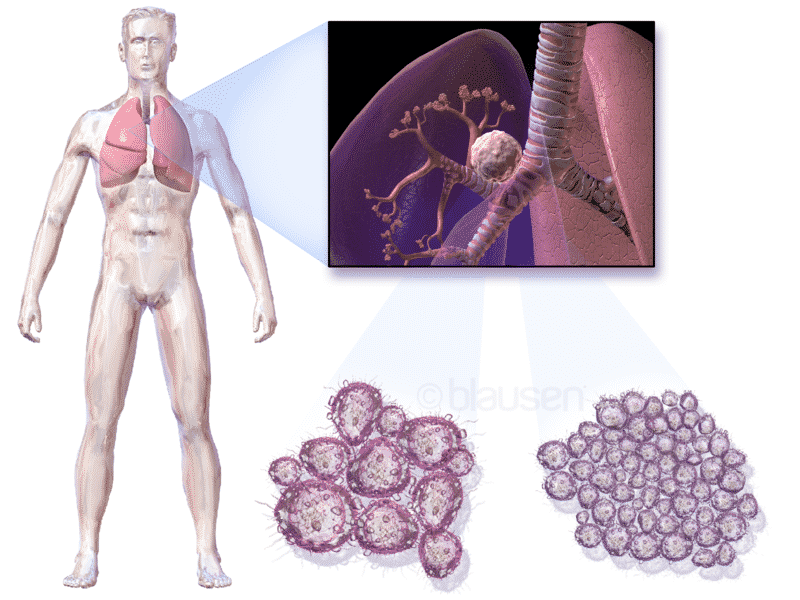 800px-Blausen_0619_LungCancer.png